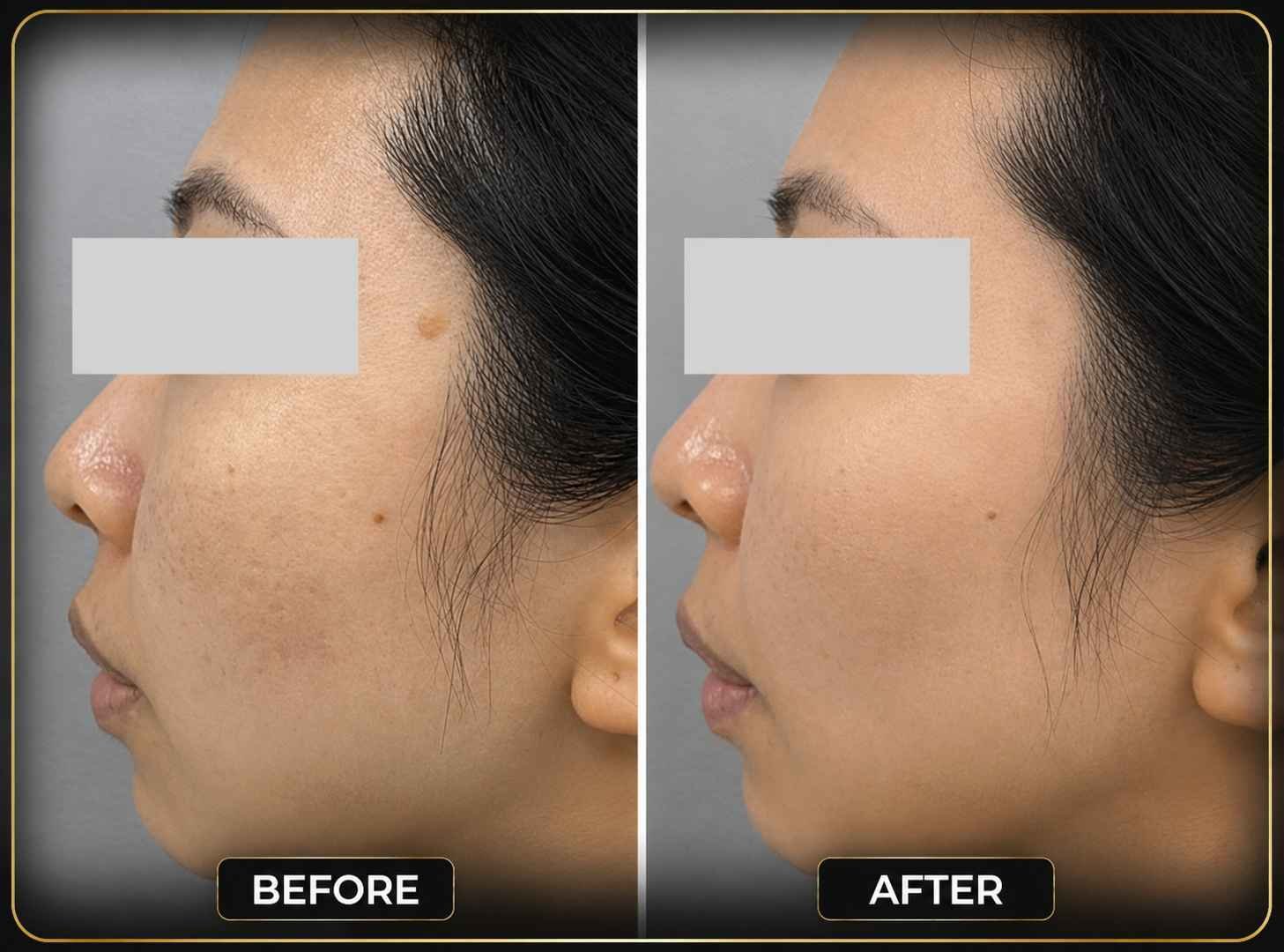 Mole Removal - 30 Minutes